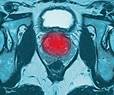 Invasive early prostate cancer treatments not always needed Logo
